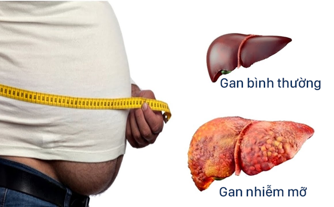 gan nhiễm mỡ